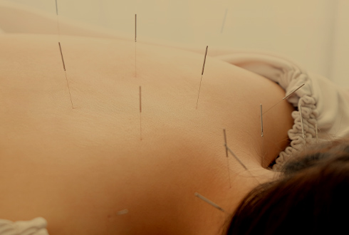 Acupuncture 鍼・鍼灸の魅力