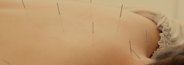 Acupuncture 鍼・鍼灸の魅力